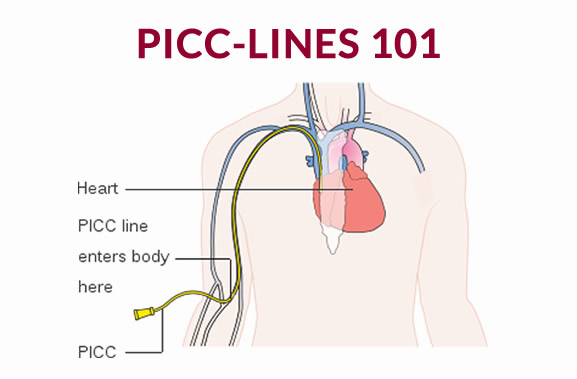 What To Know About PICC Lines and Ports | Cancer 101